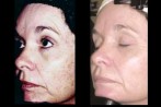 laser-facial-4