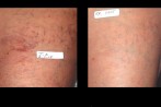 laser-veins-2 laser-veins-2