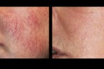 laser-veins-4 laser-veins-4