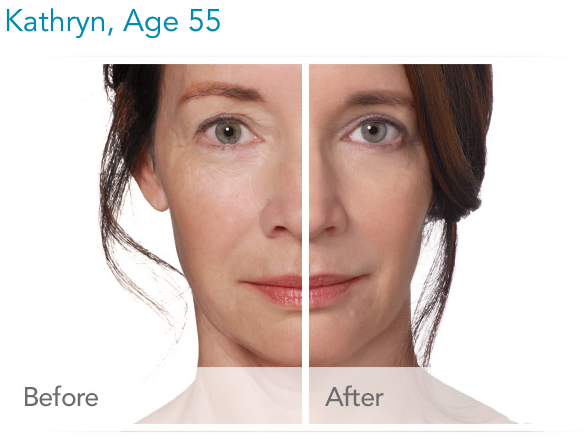 Before & After Photos RADIESSE® Volumizing Filler