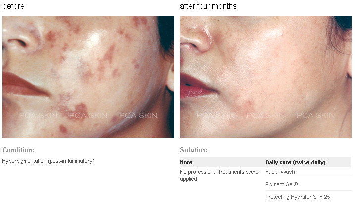 Before and After PCA Skin