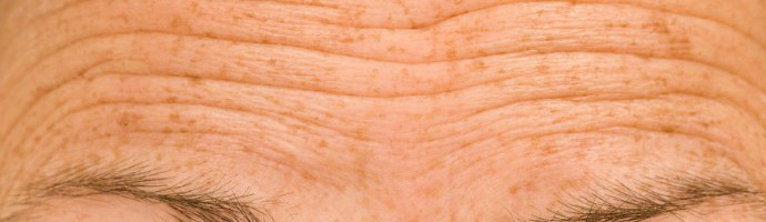 forehead skin wrinkles As we age our skin forms wrinkles due to loss of elastin and collagen.